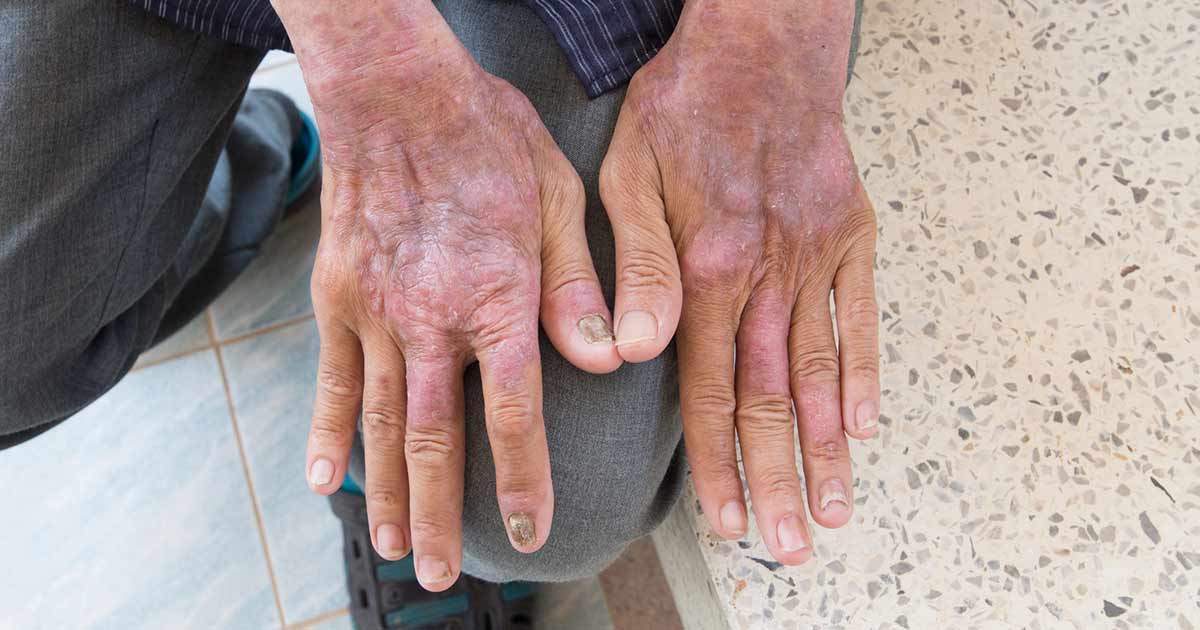 Contact Dermatitis: Types, Symptoms, Causes, and Treatment - Allergy ...