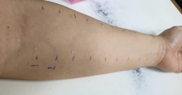 An arm undergoing an allergy test is shown with various small droplets applied to the skin and markings beside each droplet.