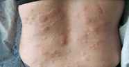 Chronic Idiopathic Urticaria CIU Allergy Asthma Network Chronic Idiopathic Urticaria CIU Allergy Asthma Network