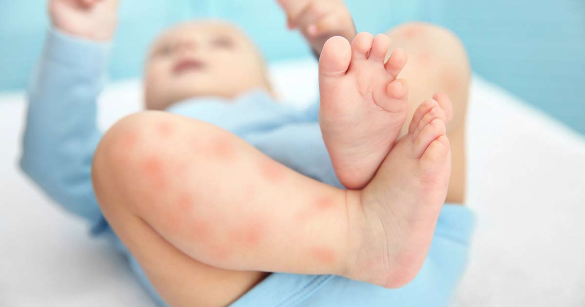 A baby experiencing infant anaphylaxis lies on its back with visible red spots or rashes on its legs, wearing a light blue outfit—its tiny feet in the foreground.