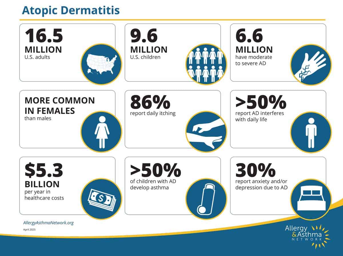 Infographic about atopic dermatitis: 16.5M U.S. adults and 9.6M children affected; 6.6M moderate-severe cases; more common in females; 86% itch; >50% report life interference; $5.3B costs; 30% report anxiety/depression.