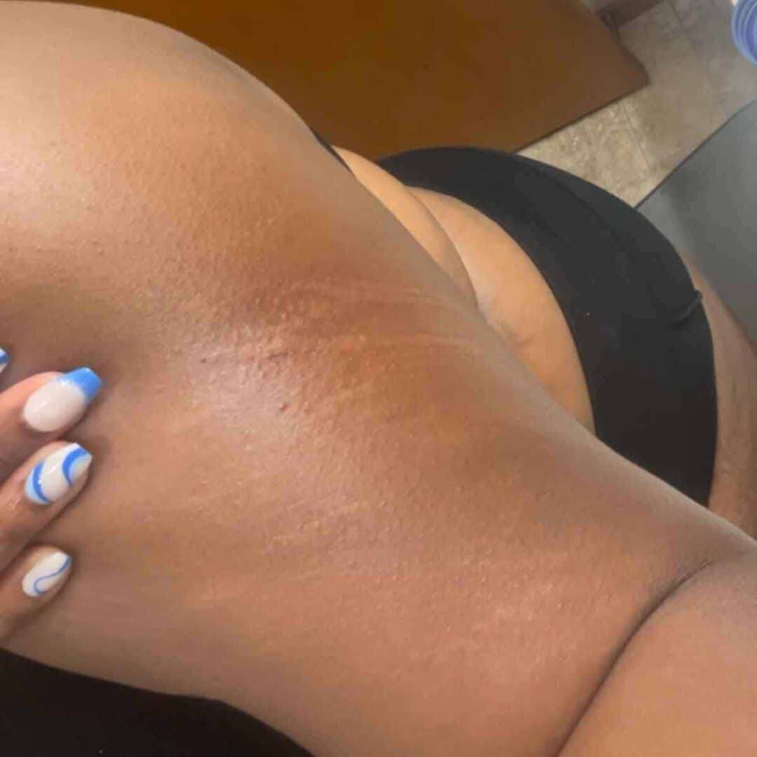 Close-up of a person’s underarm with visible hyperpigmentation and textured skin. The person has manicured nails with blue and white nail art and is wearing a black garment.