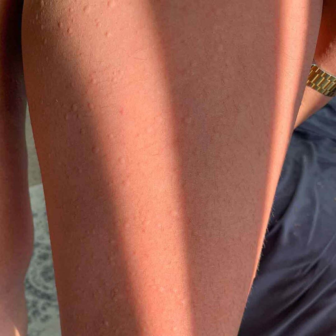Close-up of a person's sunburned arm with visible redness, small raised bumps, and a gold wristwatch. Part of their black clothing is also visible.