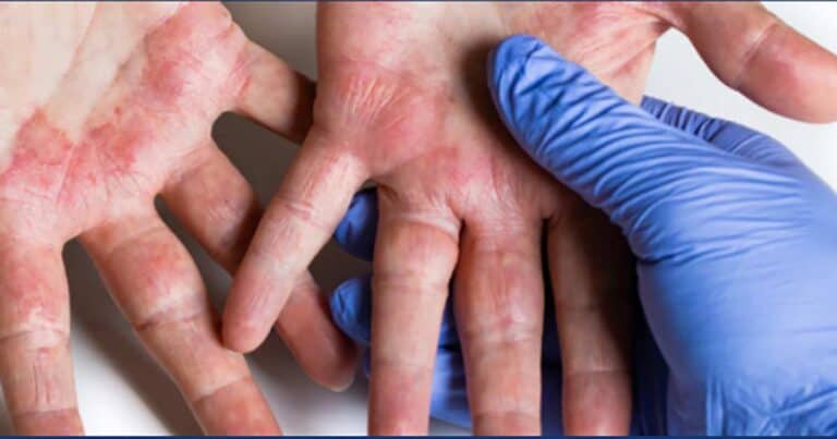 A gloved hand examines another person's palm, which shows signs of redness, dryness, and irritation, suggesting a possible skin condition.