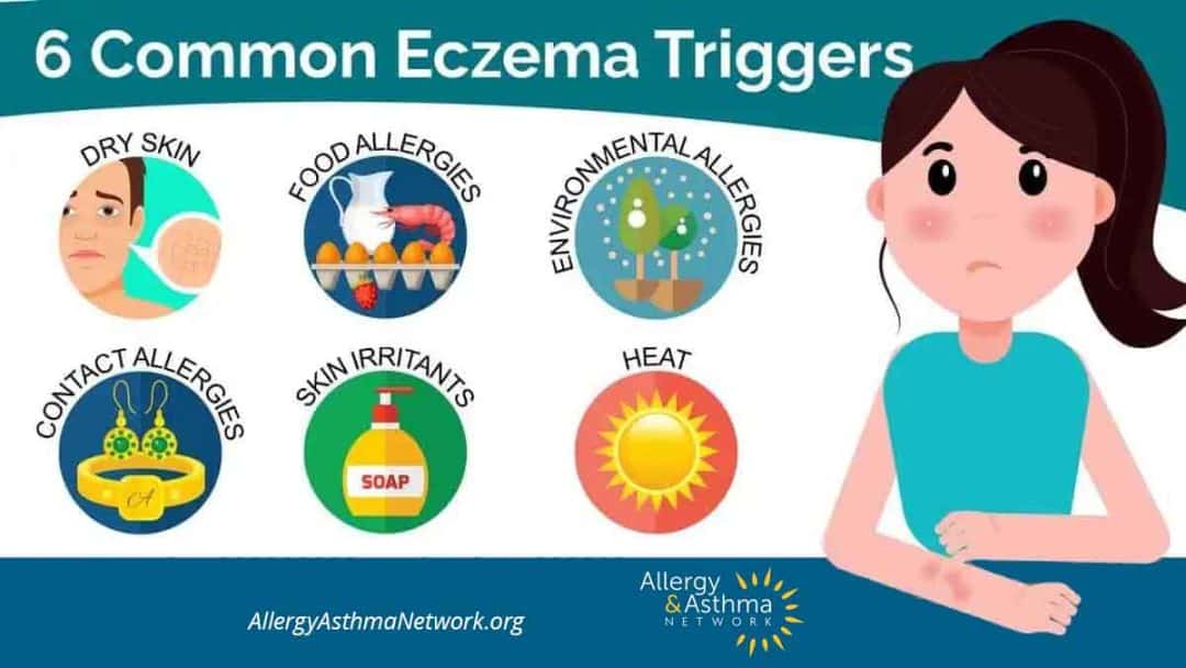 Infographic showing a woman scratching her arm with eczema and six common eczema triggers: dry skin, food allergies, environmental allergies, contact allergies, skin irritants, and heat, with icons for each.