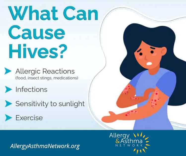 Illustration of a worried woman with red hives on her arms and chest. Text lists causes of hives: allergic reactions, infections, sensitivity to sunlight, and exercise. Allergy & Asthma Network logo and website appear below.