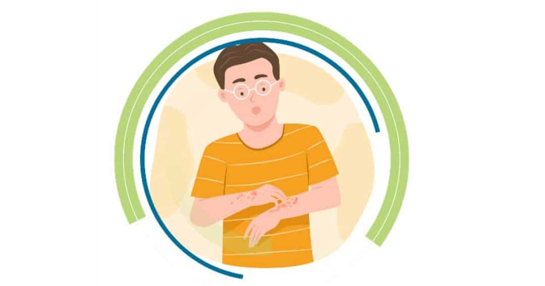 Illustration of a person with glasses wearing an orange striped shirt, showing red, irritated spots and rashes on their arms, suggesting a skin condition or allergic reaction.