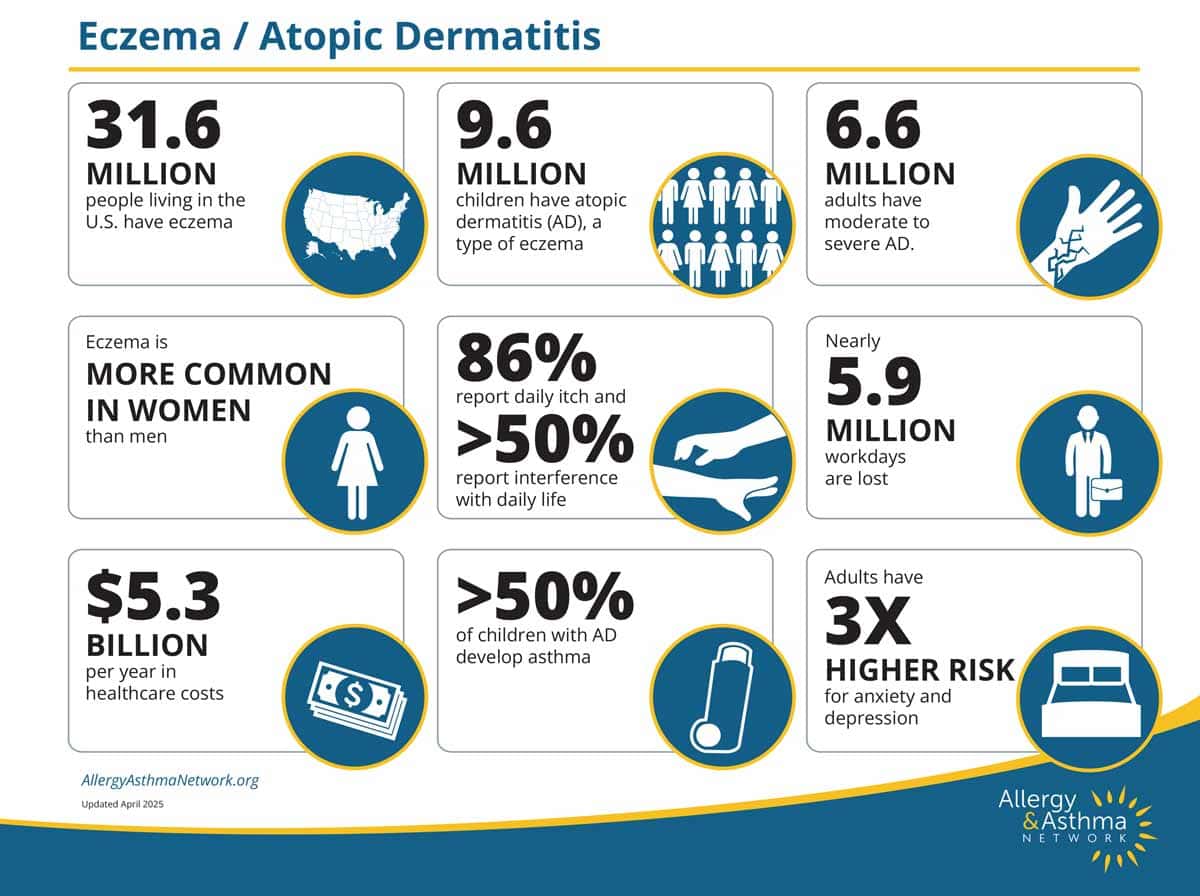 Infographic about eczema/atopic dermatitis with statistics on prevalence, impact, costs, demographics, and risks, using icons and text for data such as 31.6M people affected, higher rates in women, and increased risk for anxiety.