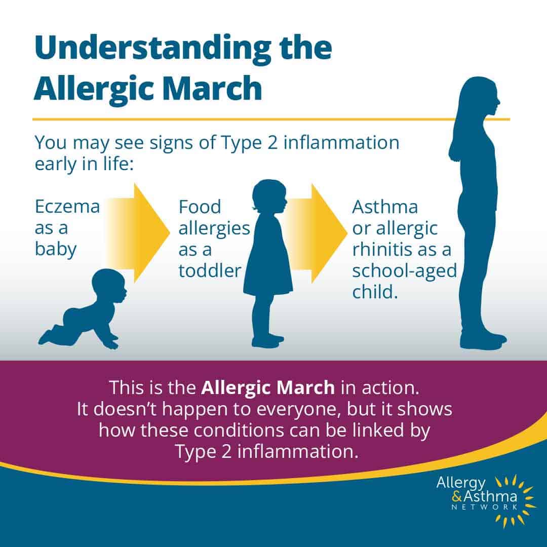 Infographic explaining the Allergic March: eczema as a baby, food allergies as a toddler, and asthma or allergic rhinitis as a school-aged child, linked by Type 2 inflammation.